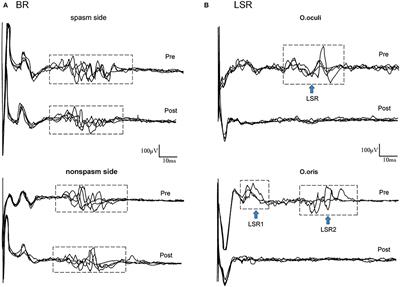 Frontiers Electroacupuncture on Hemifacial Spasm and